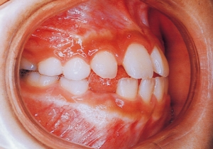 Case photo, side view, right