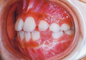 Case photo, side view, left