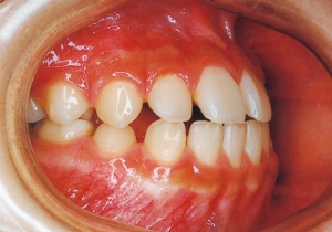 Case photo, side view, right