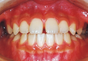 Case photo: Side view, front