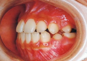 Case photo, side view, left