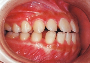 Case photo, side view, right