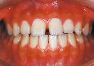 Case photo: Side view, front