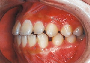 Case photo, side view, left