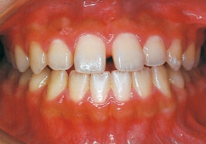 Case photo: Side view, front