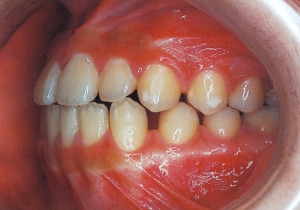 Case photo, side view, left