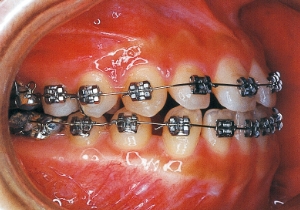 Case photo, side view, right