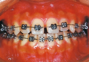 Case photo: Side view, front