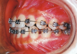 Case photo, side view, left