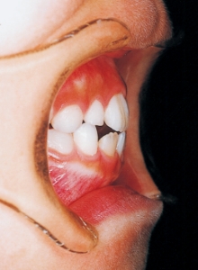 Case photo, side view, left