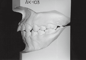 Case photo, side view, left