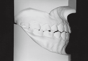 Case photo, side view, right