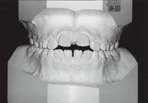 Case photo: Side view, front
