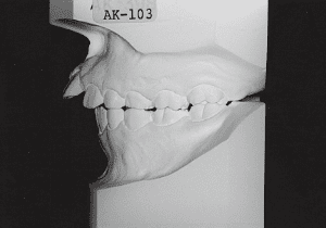 Case photo, side view, left