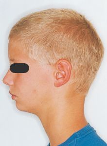 Case photo, side view, left