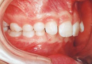 Case photo, side view, right