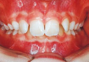 Case photo: Side view, front