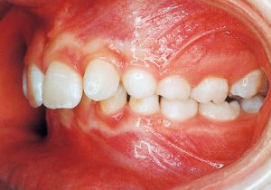 Case photo, side view, left