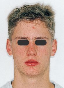 Case photo: Side view, front