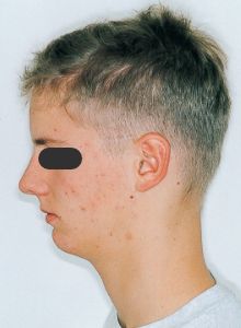 Case photo, side view, left