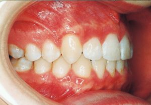 Case photo, side view, right