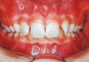 Case photo: Side view, front