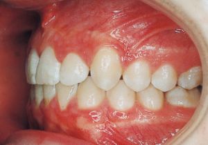 Case photo, side view, left