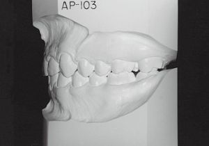 Case photo, side view, left