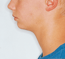 Case photo, side view, left