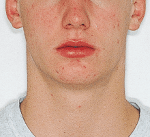 Case photo: Side view, front