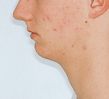 Case photo, side view, left