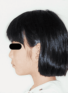 Case photo, side view, left