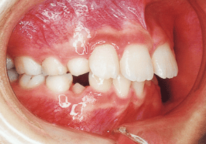 Case photo, side view, right