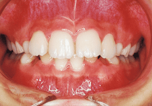 Case photo: Side view, front