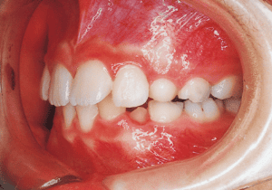 Case photo, side view, left