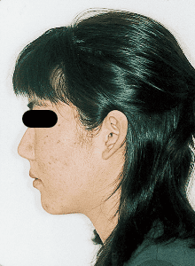 Case photo, side view, left