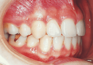 Case photo, side view, right