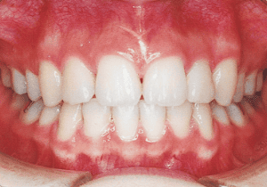 Case photo: Side view, front