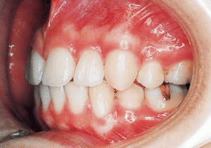 Case photo, side view, left