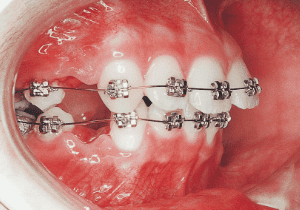 Case photo, side view, right