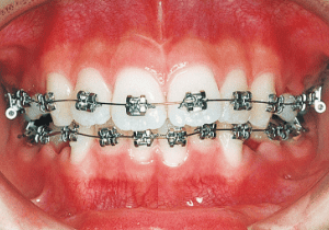 Case photo: Side view, front