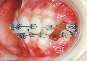 Case photo, side view, left