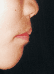 Case photo, side view, right