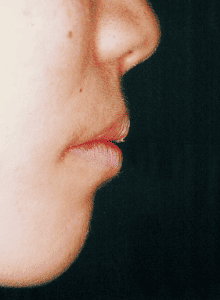 Case photo: Side view, front