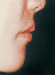 Case photo, side view, left