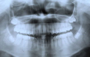 上下のあごと歯のレントゲン(パントモ)