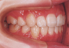 治療後のきれいな歯並び