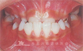 【症例４】歯列崩壊状態からの矯正治療