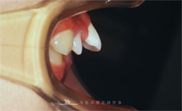 【症例５】下あごの成長で上突咬合を治療