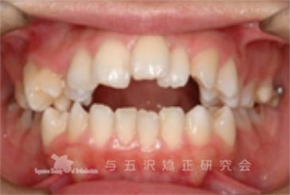 【症例６】出っ歯・歯並び・突き出た口元の改善